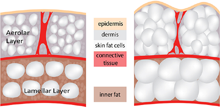 cellulite-layers-450x226