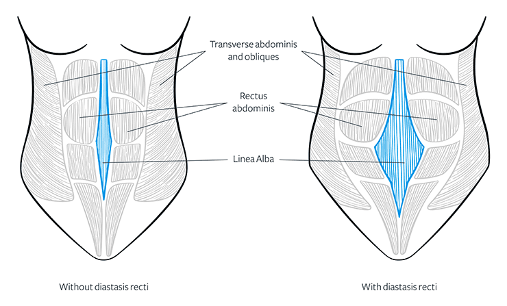 Diastasis Recti Abdominis (DRA)