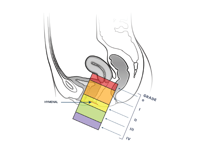 Weightlifter Rectal Prolapse