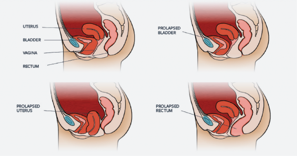 Pelvic Organ Prolapse - 5 Considerations For Training With POP