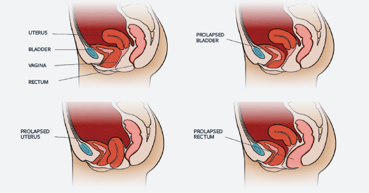 Weightlifter Rectal Prolapse