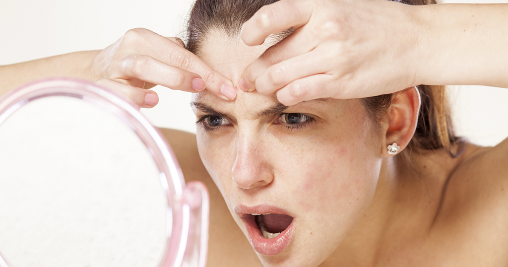 3 Medical Conditions That Cause Acne 2