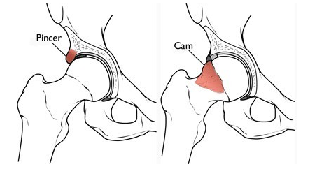 Image source: http://orthoinfo.aaos.org/topic.cfm?topic=A00571