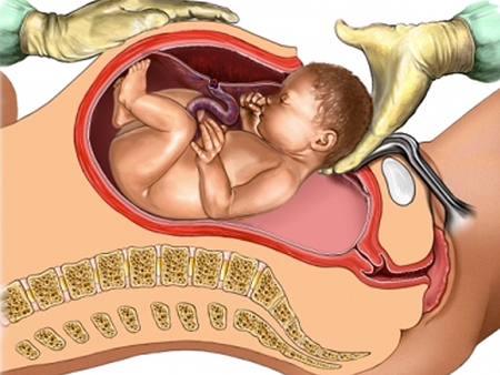 Driving After a C-Section: How Long You Should Wait