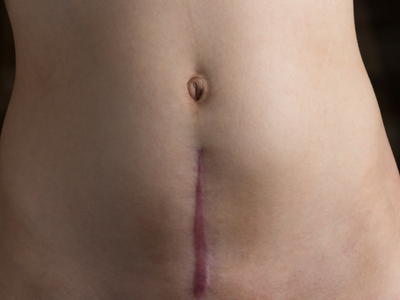 C-Section Scars - How to Care for Your C-Section Scar
