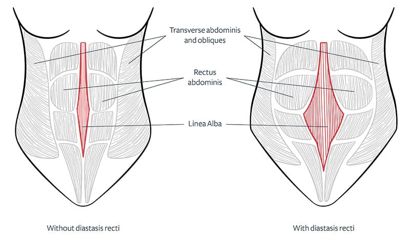 Figures showing with and without diastasis recti